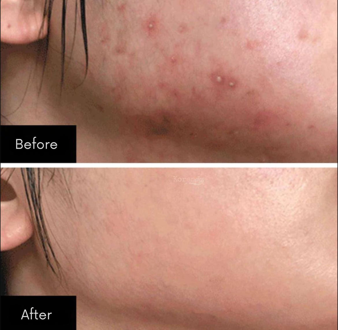 Some By Mi AHA. BHA. PHA 30Days Miracle Toner  - 150ml | سوم باي مي تونر مقشر بالاحماض للوجه - 150 مل