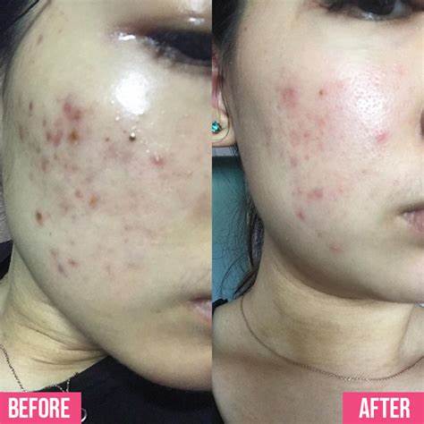 Effaclar Gel Facial Wash - 200 ml | Efficlar Foaming Gel Wash - 200 ml