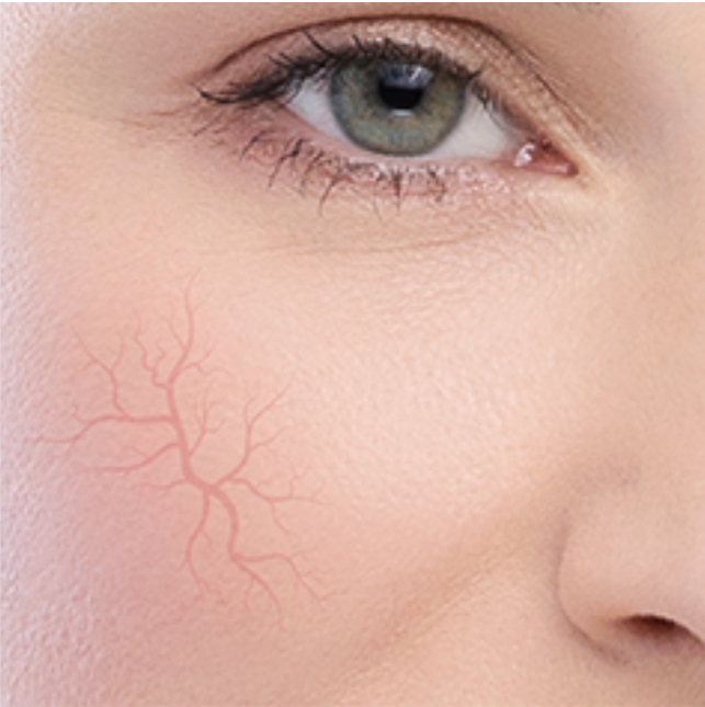 DERMEDIC Redness calm rosacea prone skin Cleansing - 170ml | ديرمديك غ ...