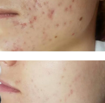 Perfect Image TCA 15% skin peel - 30ml | بيرفكت إيمج سيروم مقشر 15% من حمض TCA - 30 مل