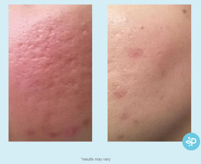 Perfect Image Lactic 50% Gel Peel - 30ml | بيرفكت ايمج مقشر جل باللاكتك اسيد ٥٠٪؜ - ٣٠ مل
