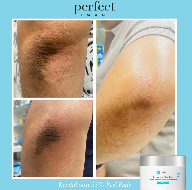 Perfect Image Revitaboost Peel Pads - 30pads | بيرفكت إيمج شرائح مقشر - 30 شريحة