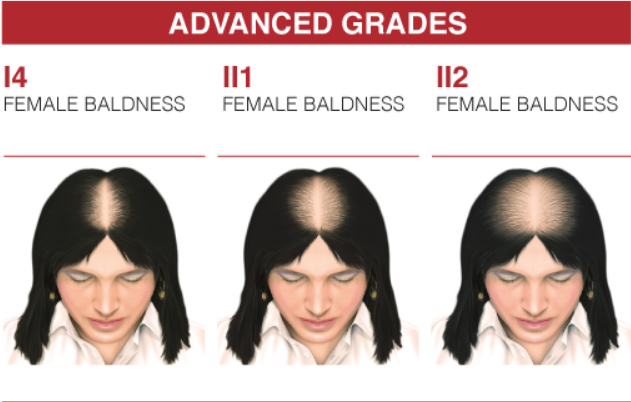 CRESCINA Transdermic HFSC Complete Treatment 1300 - 3.5x10+10 | كريشنا أمبولات ضد تساقط الشعر للنساء عيار 1300 - 3.5 مل x 10+10