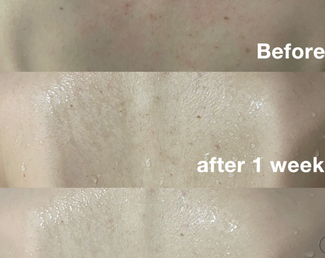 Medicube RED ACNE BODY WASH 2.0 - 400g | ميدي كيوب غسول للجسم ضد حب الشباب - ٤٠٠ غرام