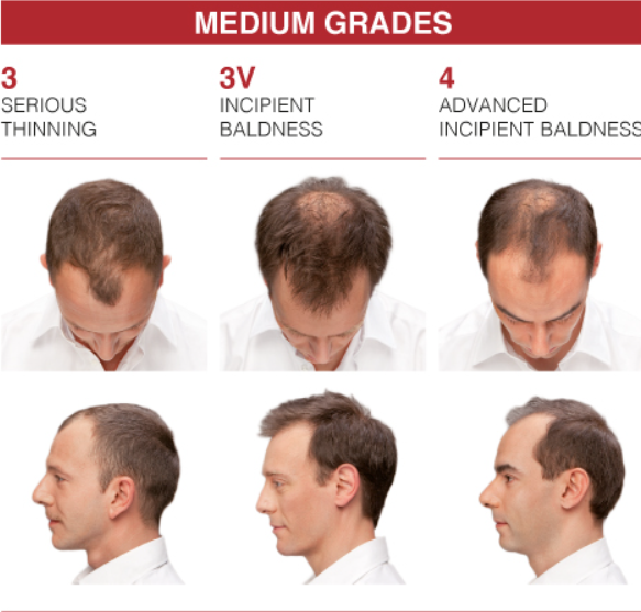 CRESCINA RE-Growth Anti-Hair Loss Complete Treatment 500 man - 10+10x3.5ml | كريشنا امبولات متكاملة ضد تساقط الشعر عند الرجال - 10+10 x 3.5 مل