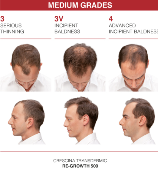 CRESCINA Transdermic Re-Growth Hfsc - 100% Formula - 20x3.5ml | كريشنا امبولات ضد تساقط الشعر عند الرجال - 20x3.5 مل
