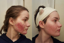جاري تحميل الصورة , Acne Control Gel Salicylic Acid Acne Treatment - 40ml
