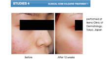 جاري تحميل الصورة , Anti-Acne Serum - 30ml

